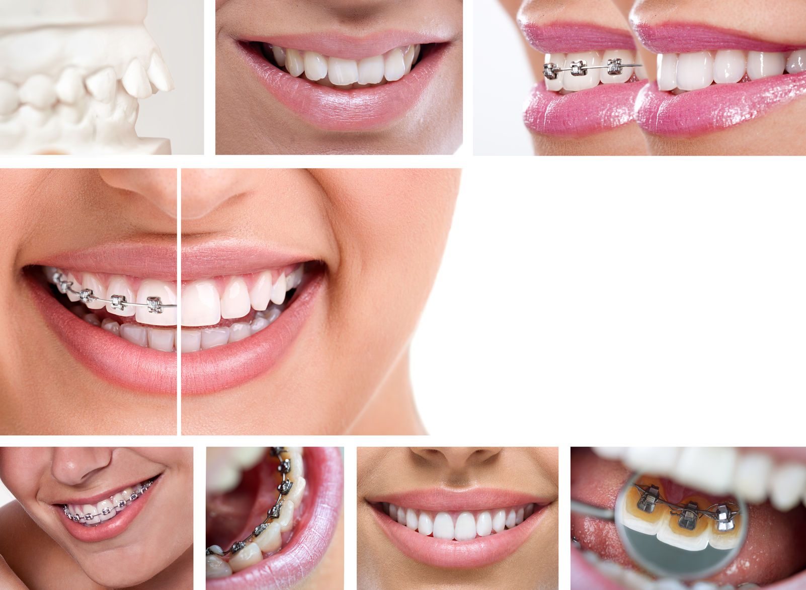 Aparat dentar