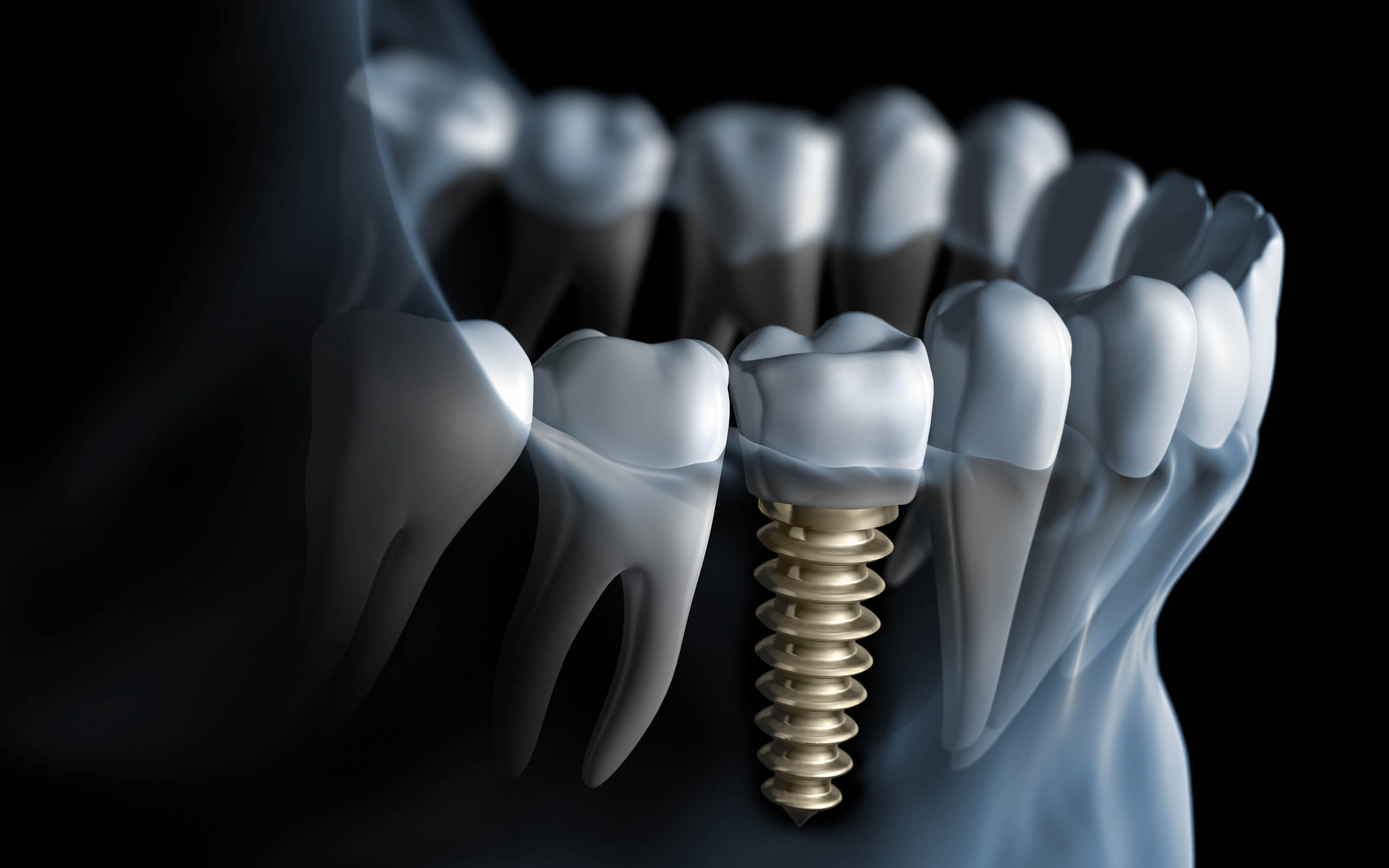 Avantajele implanturilor dentare