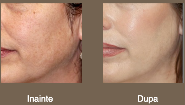 peeling chimic